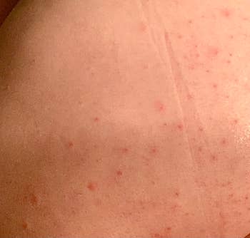 special products problem solving a reviewer photo of their skin with many blemishes