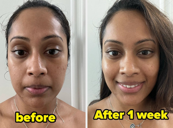 Model before using the serum with some hyperpigmentation and dullness, labeled