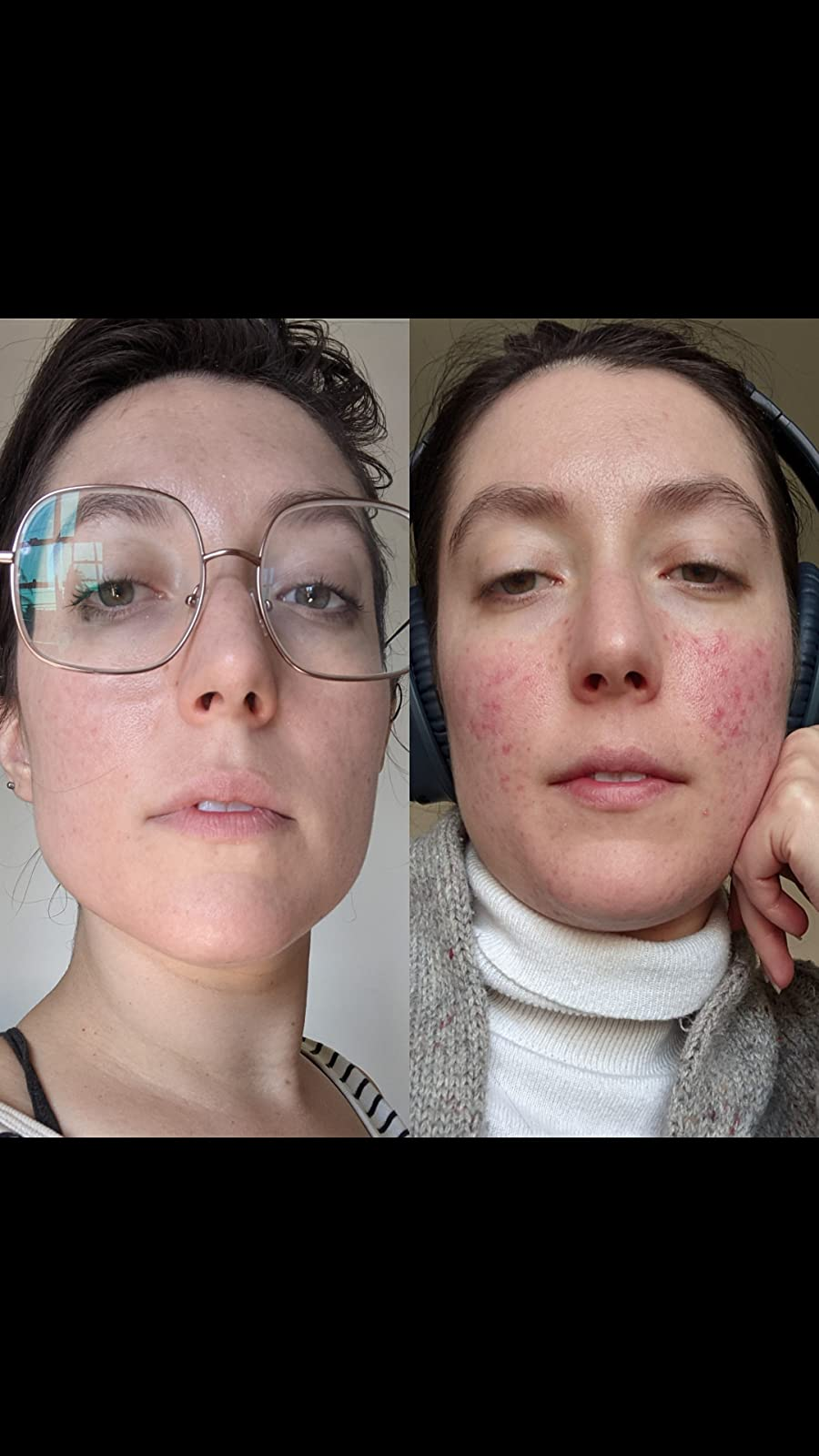 reviewer before and after photos, showing their skin with acne on the right and their skin looking much clearer after using the cleanser on the left