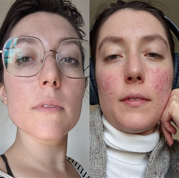 reviewer before and after photos, showing their skin with acne on the right and their skin looking much clearer after using the cleanser on the left