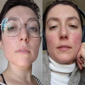 reviewer before and after, showing their skin with acne on the right and their skin looking much clearer after using the cleanser on the left