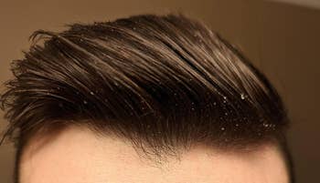 Close-up of a reviewer's hair with visible dandruff flakes