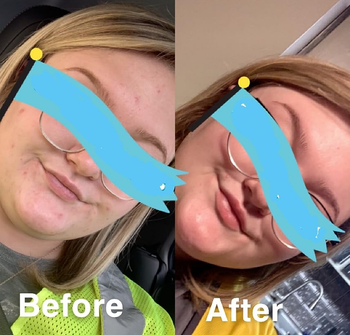 before and after of reviewer using face wash and the after picture shows clearer skin