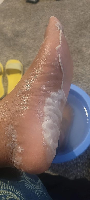 the side of reviewer's foot shedding skin