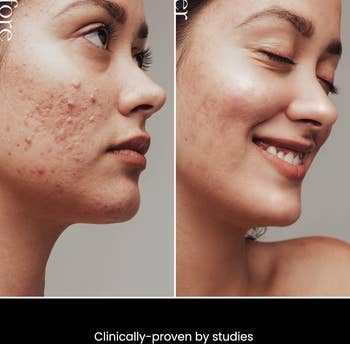 Side-by-side comparison of a person's skin before and after using a skincare product, showing improvement