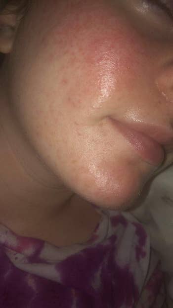 The aforesaid  reviewer with clearer, much  hydrated skin