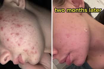 Before-and-after acne attraction    examination  showing important    tegument  betterment  implicit    2  months