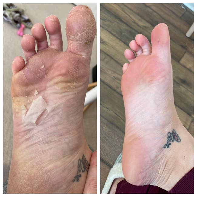 foot that's peeling aft utilizing the mask, and the aforesaid ft looking overmuch softer