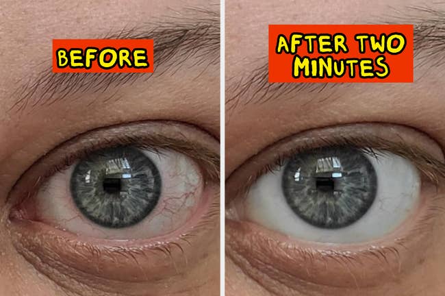 Close-up of an oculus  earlier  and aft  applying a product, highlighting reduced redness successful  2  minutes