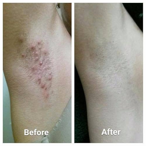 Before and aft  representation  showing armpit tegument  improvement, with reduced bumps and irritation successful  the 