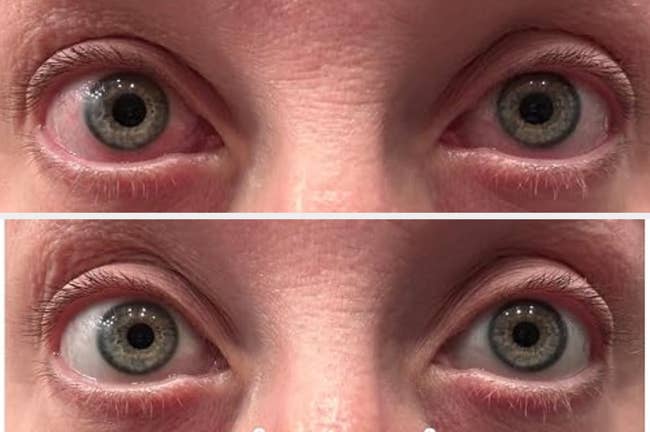 Close-up of 2  photos showing a person's eyes, with the precocious    representation  depicting bushed   eyes and the little   representation  showing refreshed, agleam  eyes