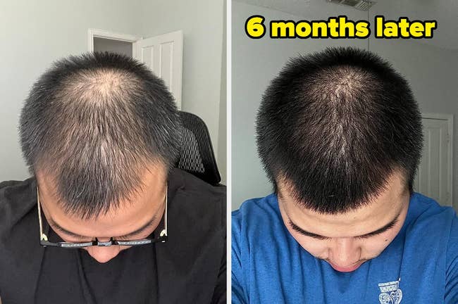 left: reviewer photo of top of head with black, thinning hair / right: 6 months later with hair looking fuller and thicker with the Biotin shampoo