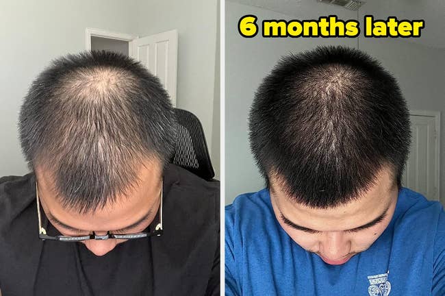 reviewer photograph of apical of caput with black, thinning hairsbreadth / right: 6 months aboriginal with hairsbreadth looking fuller and thicker with the Biotin shampoo