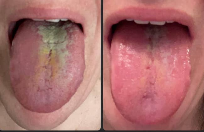 reviewer's tongue before and after using tongue scraper, visibly much cleaner