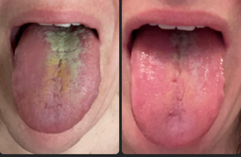 reviewer's tongue before and after using tongue scraper, visibly much cleaner