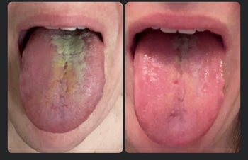 reviewer's tongue before and after using tongue scraper, visibly much cleaner