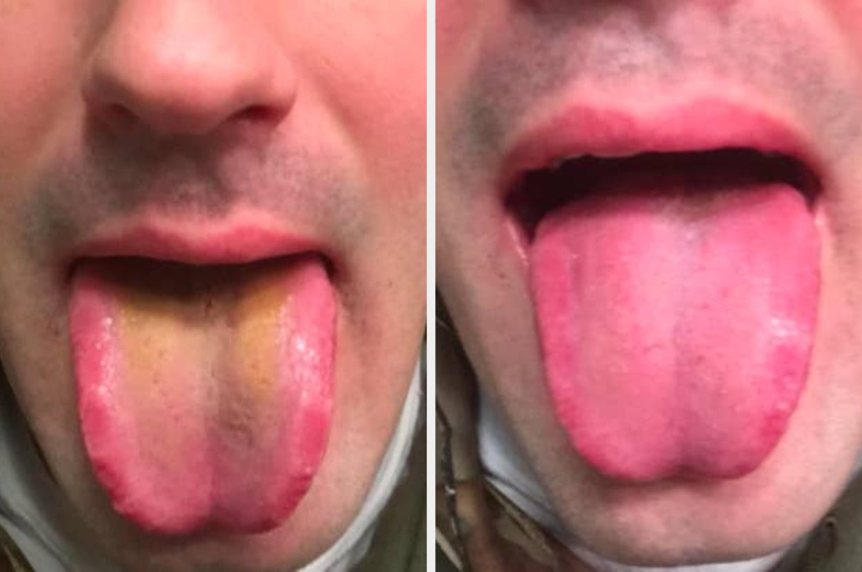 the reviewer's tongue before and after using tongue scraper
