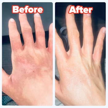 reviewer before and after of their discolored hand and then their even, glowing hand (from using the oil)