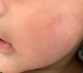 Reviewer's child's cheek three days later, with skin clear and smooth