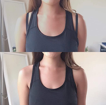 person before and after using razor bra strap clips on bra under a tank top