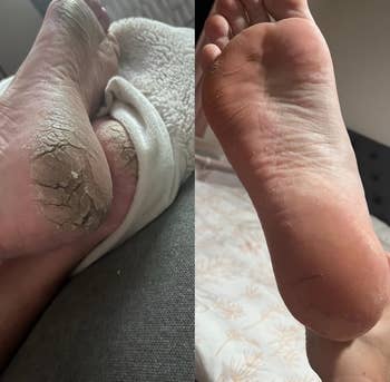 before image of another reviewer's severely cracked feet and an after image of their feet smooth and hydrated