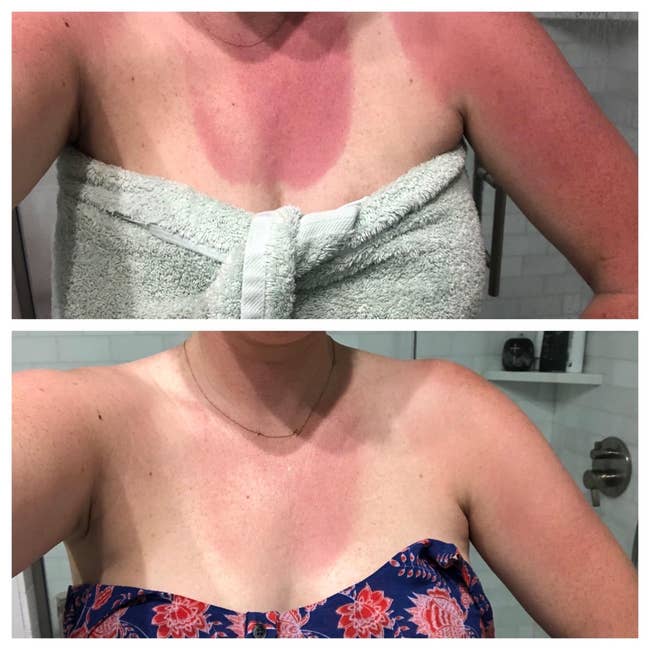 Two images showing a person with a visible sunburn on their chest. The top photo shows more redness than the bottom, where it has lessened