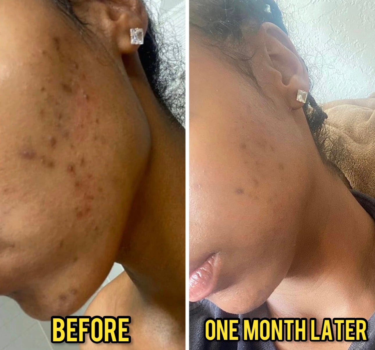 I TRIED OLIVE OIL SKINCARE FOR A MONTH - BEFORE & AFTER ACNE SKINCARE HACKS