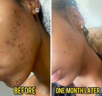Reviewer with many dark spots and acne spot in the first pic and with much clearer skin a month after using the soap