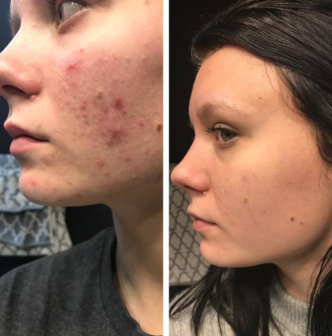 reviewers skin before and after using cleanser, skin is much clearer after