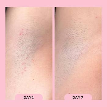 Before and after images of underarms showing fewer razor bumps and less redness over seven days