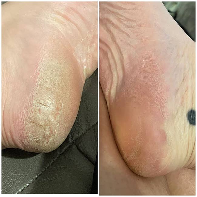 Before and aft images of a foot, showing betterment successful tegument texture and smoothness