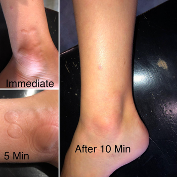 Reviewer photo of a foot with bug bites, five minutes after using the tool, and ten minutes with no bug bites shown