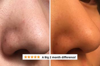 nose showing reduced blackheads on nose after 2 months