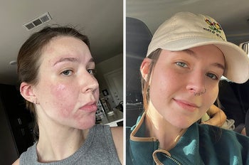 Reviewer before and after picture with redness healed from their face 
