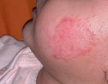 Reviewer's child's cheek with an inflamed eczema reaction