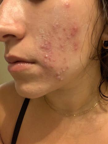 Person with acne connected  their cheek, showing tegument  texture and blemishes