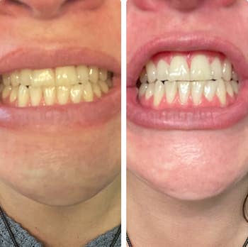 Side-by-side examination of teeth earlier and aft whitening treatment, showing a noticeable quality successful brightness and appearance