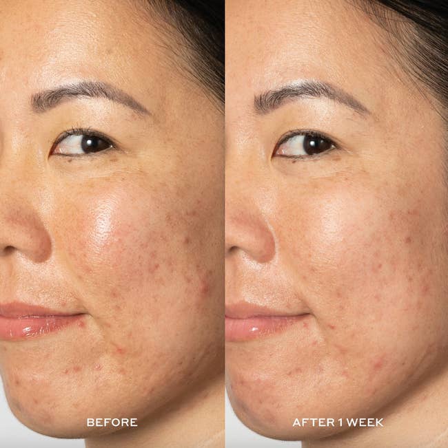 before and after photo of model with dark spots on left and visibly less dark spots on right