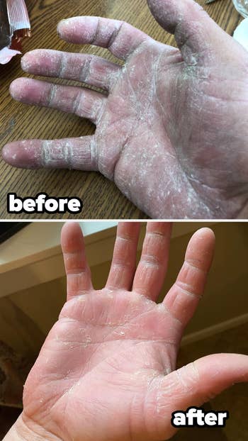 Before and after images showing a significant improvement in hand skin condition. The 