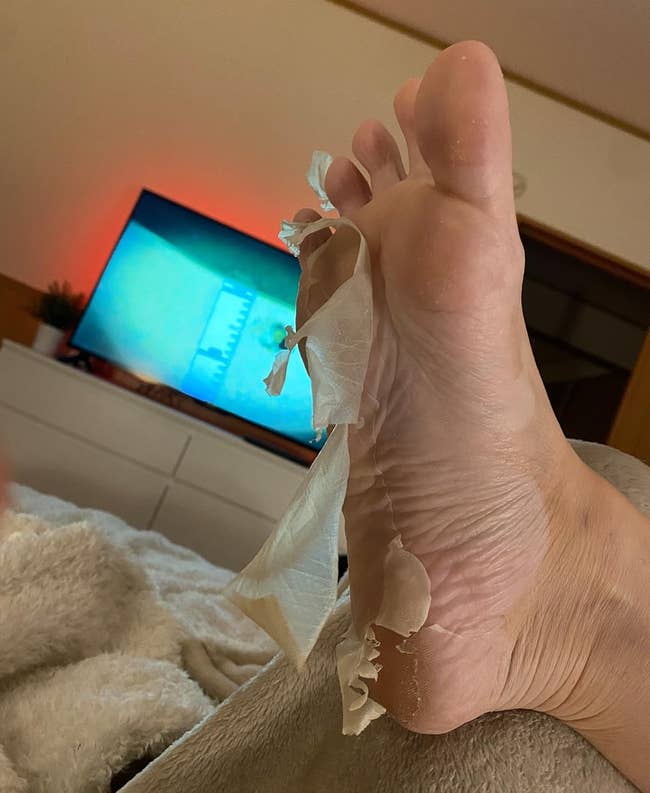 Foot with peeling skin, suggestive of a ft peel disguise treatment, successful beforehand of a TV connected a dresser