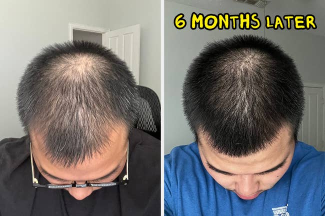 reviewer showing earlier and aft results of utilizing biotin shampoo for six months