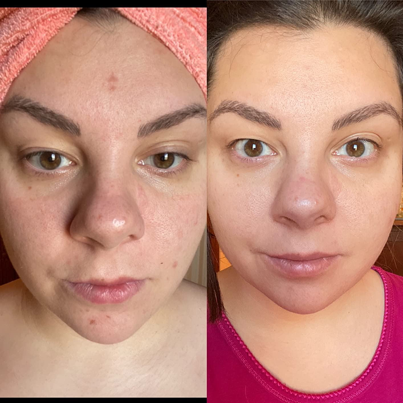 reviewer's face with some acne spots on forehead and chin (left) and same reviewer's face (right) with less acne spots after using the serum for a week