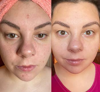 reviewer's face with some acne spots on forehead and chin (left) and same reviewer's face (right) with less acne spots after using the serum for a week