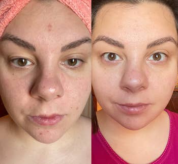 reviewer's face with some acne spots on forehead and chin (left) and same reviewer's face (right) with less acne spots after using the serum for a week