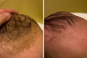 Before and after images showing improved scalp condition on an infant, highlighting hair growth and reduced irritation