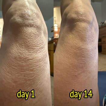 Comparison of tegument  texture connected  knee, showing betterment  from time  1 to time  14