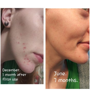 before photo of reviewer with a skin break out one month after using the moisturizer next to a photo of their skin looking clear seven months later