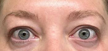 before image of a reviewer's dark and puffy under eyes