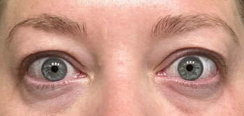 before image of a reviewer's dark and puffy under eyes