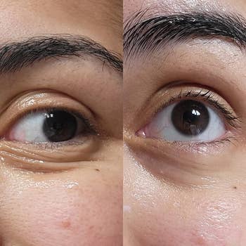 Before and after comparison of an eye with fine lines and then less fine lines